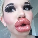 Si fa 20 iniezioni alle labbra ma le vuole ancora piu grand