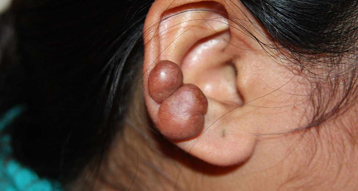 Cheloidi cosa sono e come trattarli in modo naturale