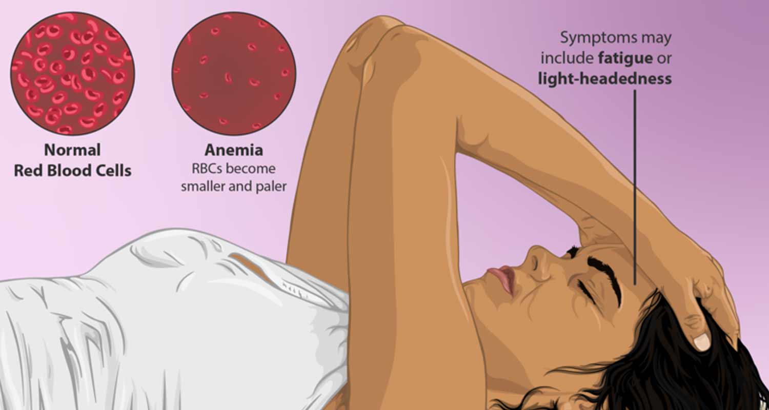 Anemia cura naturale e trattamenti